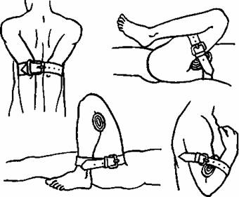 Тимчасова зупинка згинанням в суглобах при артеріальній кровотечі з: а) підключичних артерій;  б) стегна; в)  гомілки г) передпліччя;