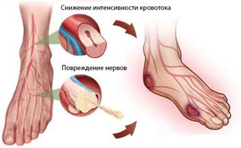 Нейропатіческая форма.