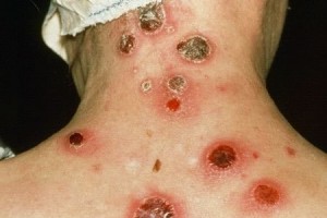 Туляремія – інфекційна хвороба тварин і людини